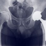 protesi anca mini invasiva