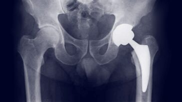 protesi anca mini invasiva