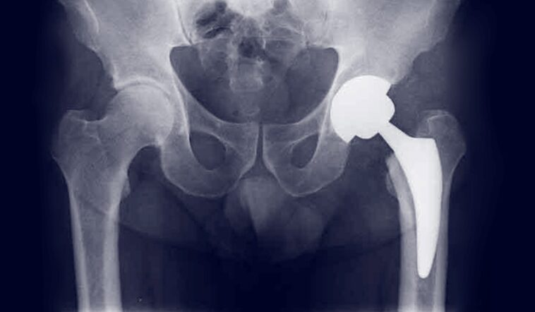 protesi anca mini invasiva